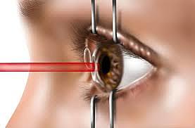 Laser Eye Surgery (LASIK)