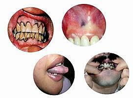 PLINIO Y GALENO TOXICIDAD POR MERCURIO