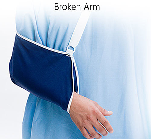 when i broke my arm