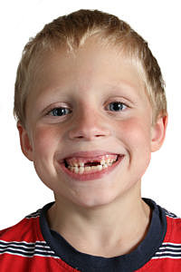 Lost my two front teeth