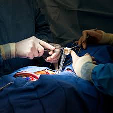 Human Heart Transplant