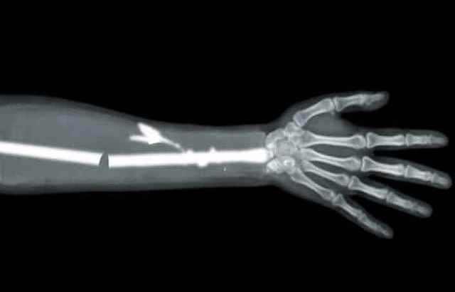 Quan em vaig trencar el braç