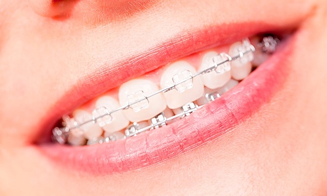 Em van posar els brakets