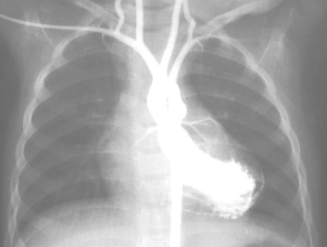 Angiocardiography for infants with congenital heart disease