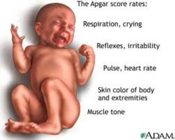 Virginia Apgar develops the APGAR scoring for infants.