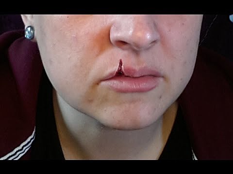 Un gos hem va partir el llavi.