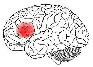 Broca