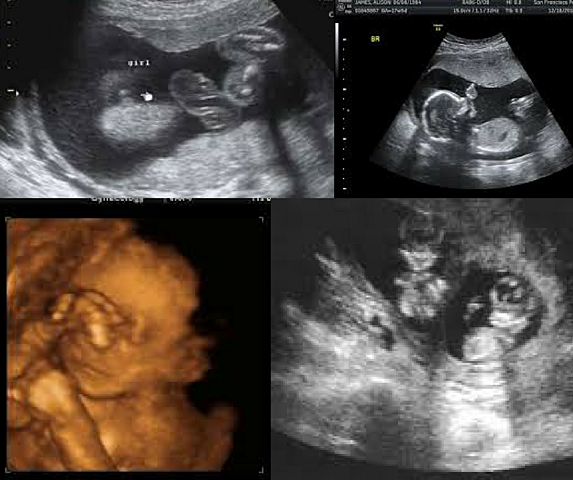 6 month pregnancy BABY