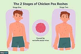 Vaccine for Chicken pox is developed