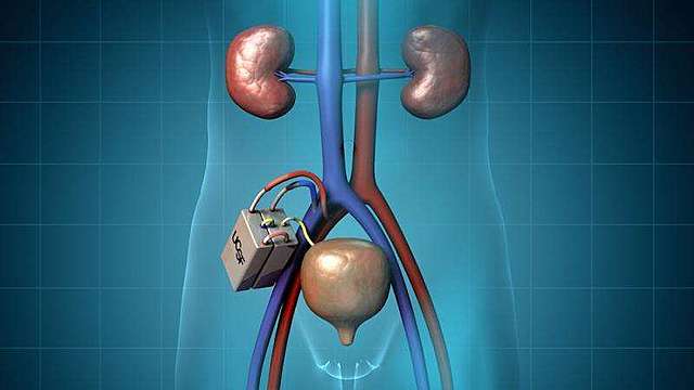 Artificial Kidney