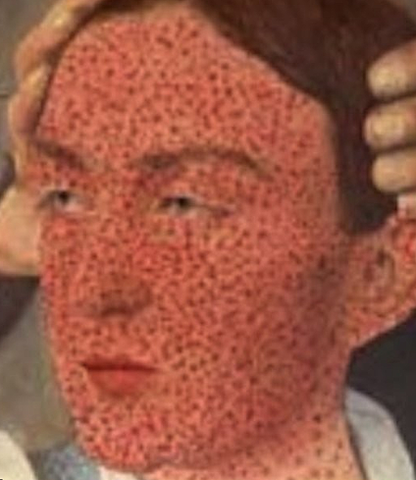 small pox is eradicated