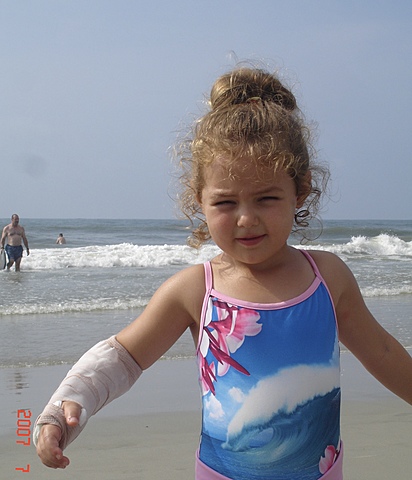 Fui a la playa y rompí mi brazo.