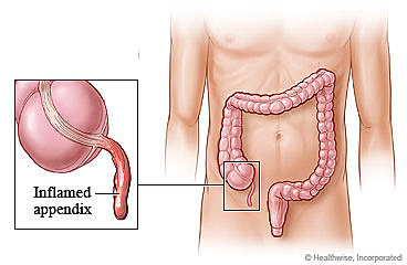 Appendectomy