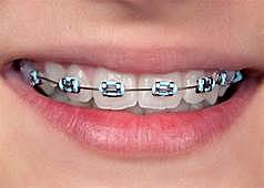 brackets