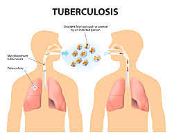 First vaccine for tuberuclosis