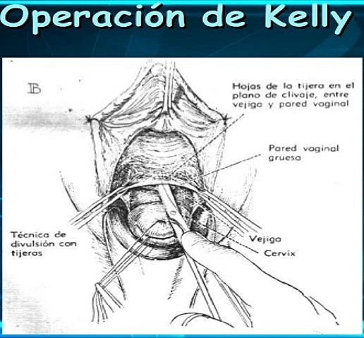 PLICATURA DE KELLY