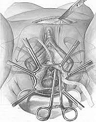 PLICATURA DE KELLY-KENNEDY