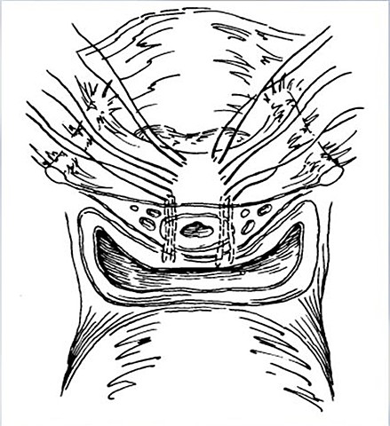 EL MARSHALL-MARSHETTI-KRANTZ