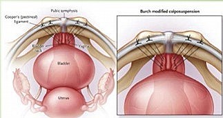 CISTOURETROPEXIA TIPO BURCH