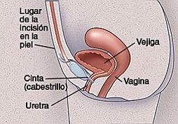 SLINGS O CABESTRILLOS