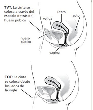 CINTA VAGINAL LIBRE DE TENSIÓN (TVT) Y CINTA TRANSOBTURADORA (TOT)