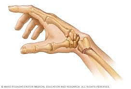 when I first broke my wrist