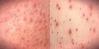 Rhaze finds the difference between small pox and measles