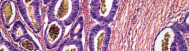 Nueva Inmunoterapia contra el cancer