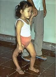 Baztanga Desagertzea