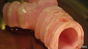 Primer trasplante de órgano sintético en Suecia