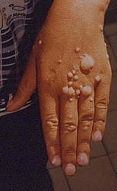 PAPILOMAREN TXERTOA AURKITU ZUTEN