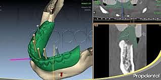 comienzo de cirugía e implantología guiadas y asistidas por ordenador