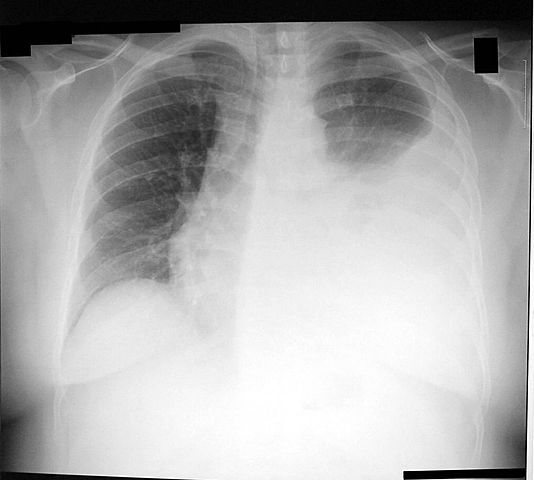 I suffered pneumonia with pleural effusion