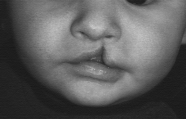 Hassan's surgery to fix his cleft lip