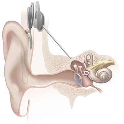 Timeline: Greame Clarks Ideas Of The Cochlear Implant