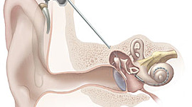 Timeline: Greame Clarks Ideas Of The Cochlear Implant