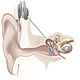 Cochlear implant