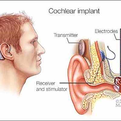 Timeline: sound- cochlear implant