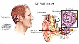 Timeline: sound- cochlear implant