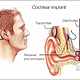 Cochlear implant
