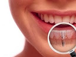 Implantología dental