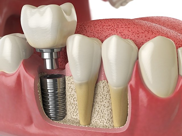 La implantología dental como opción terapéutica