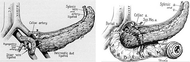 First successful pancreas transplant