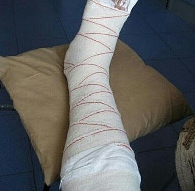 In 2015 I rubbed my leg