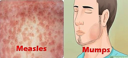 Measles and mumps virus vaccine licensed in the US