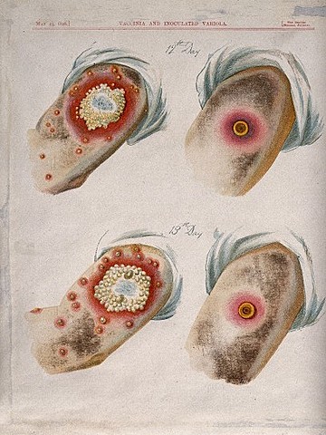 Variolation Technique