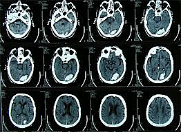 Primera sociedad neurocientifica existente (1970)