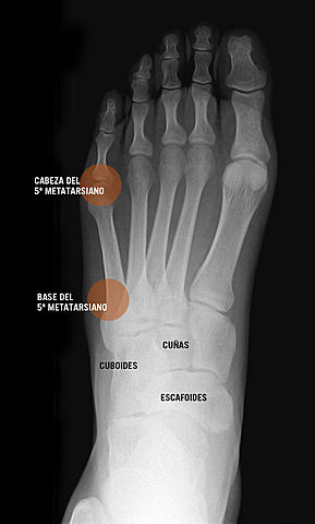 I broke the fifth metatarsal of the right foot