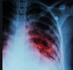 Tuberculosis vaccine