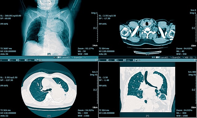 Invention of CT Scan